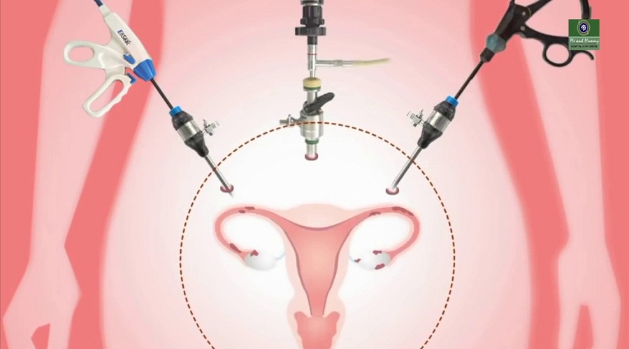 Total Laparoscopic Hysterectomy – Dr Pulkit Nandwani