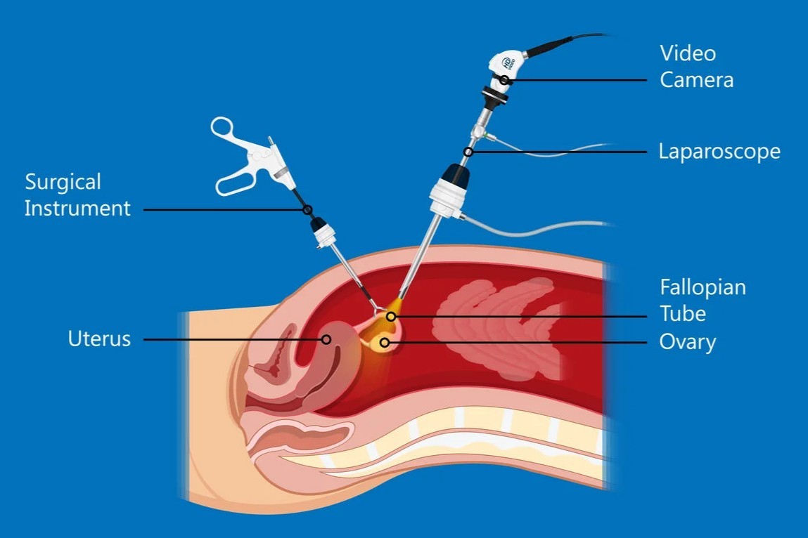 Laparoscopic-Myomectomy