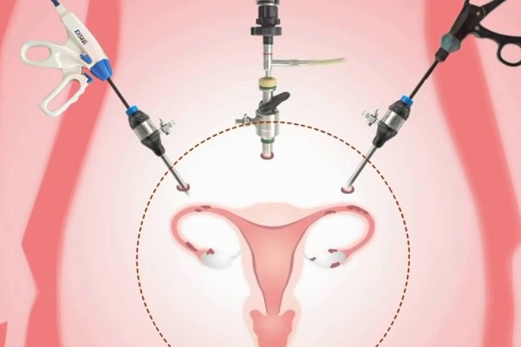 Total-Laparoscopic-Hysterectomy