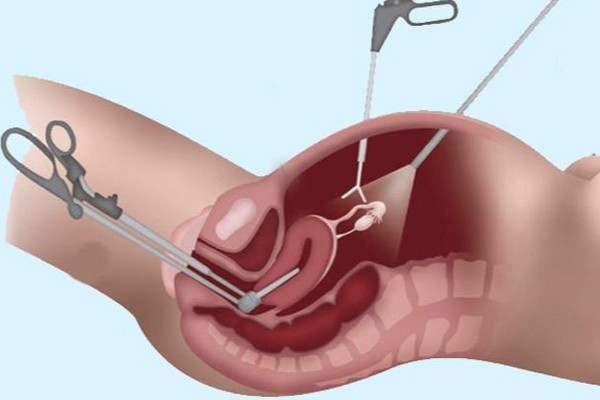 hysterectomy